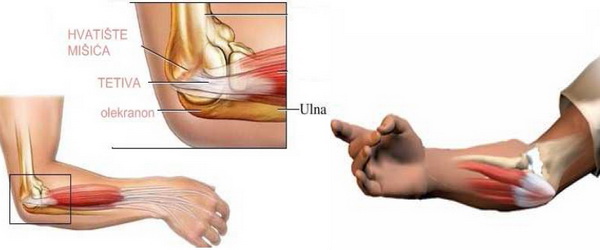 Teniski_lakat Teniski_lakat